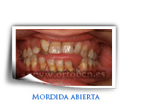 mordida abierta