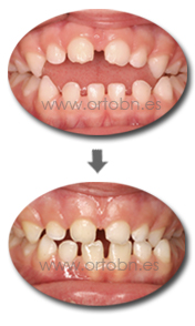 Mordida abierta chupete