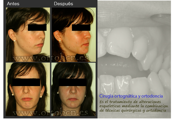 Cirugia ortognatica